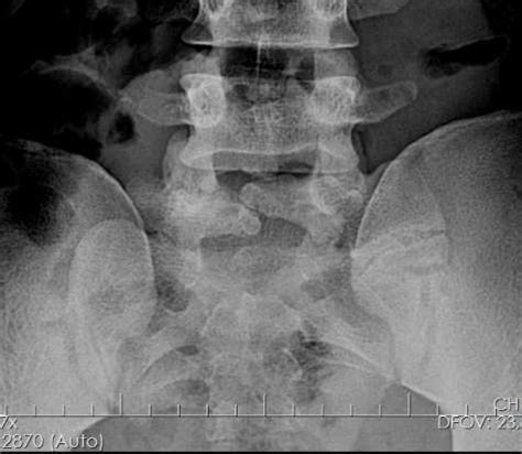 espina bifida oculta l5